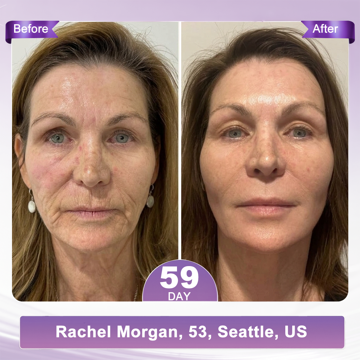 FDA Official: 𝐇𝐈𝐒𝐊𝐈𝐍® 𝐏𝐃𝐑𝐍 𝐌𝐮𝐥𝐭𝐢-𝐏𝐞𝐩𝐭𝐢𝐝𝐞 𝐌𝐚𝐬𝐬𝐚𝐠𝐢𝐧𝐠 𝐁𝐨𝐝𝐲 𝐑𝐨𝐥𝐥𝐞𝐫 𝐂𝐫𝐞𝐚𝐦- Anti-aging, Hydrating, Skin Firming & Lifting, Skin Repair, Even Tone, Acne and Dark Spot Treatment, Wart and Mole Removal, and Psoriasis Relief.