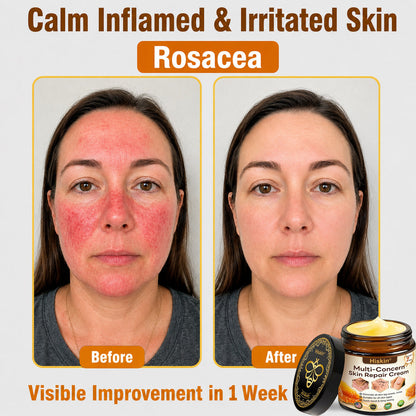HISKIN® Multi-Concern Skin Repair Cream ✨ (One powerful cream to repair inflammation, dryness, aging, pigmentation, and visible skin damage.)