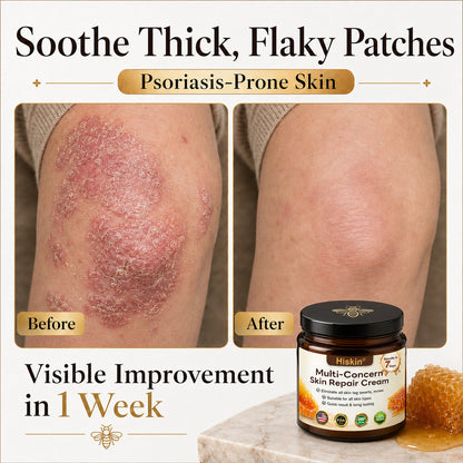 HISKIN® Multi-Concern Skin Repair Cream ✨ (One powerful cream to repair inflammation, dryness, aging, pigmentation, and visible skin damage.)