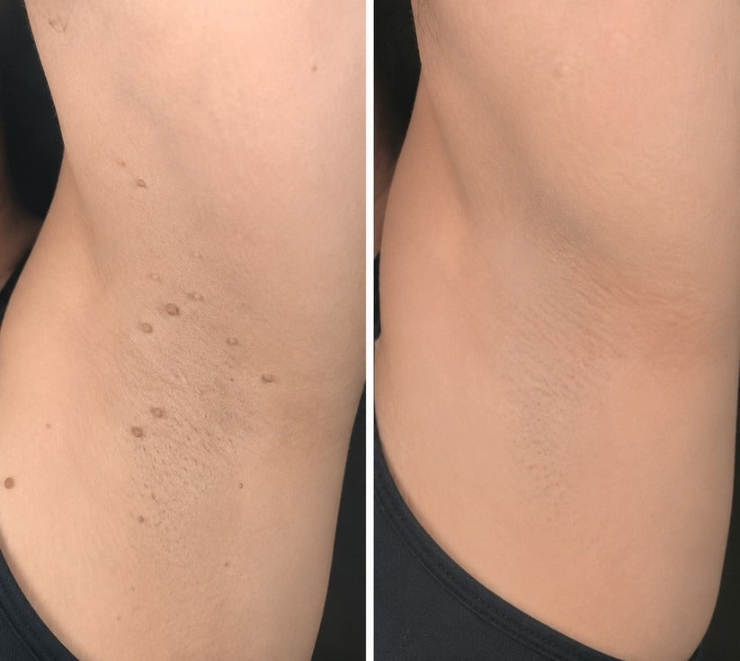 ✨Hiskin ® 2-in-1 Microneedle & Hydrocolloid Patch🍀 | Removes raised moles, acne, flat warts, and skin tags | Helps improve wrinkles, scars, and blemishes | Invisible patches for face and body