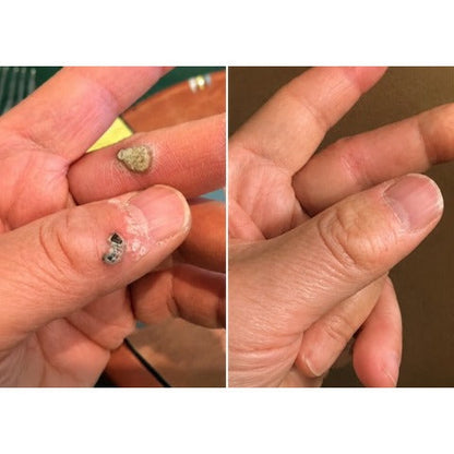 ✨Hiskin ® 2-in-1 Microneedle & Hydrocolloid Patch🍀 | Removes raised moles, acne, flat warts, and skin tags | Helps improve wrinkles, scars, and blemishes | Invisible patches for face and body