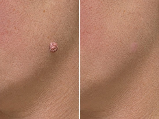 ✨Hiskin ® 2-in-1 Microneedle & Hydrocolloid Patch🍀 | Removes raised moles, acne, flat warts, and skin tags | Helps improve wrinkles, scars, and blemishes | Invisible patches for face and body